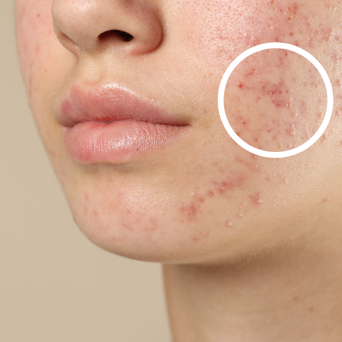 Acne Before