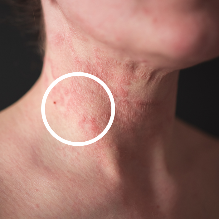 Eczema Before